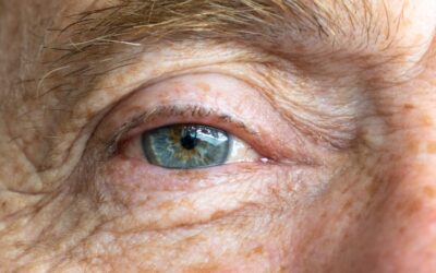 What Are Cataracts and How to Treat Them
