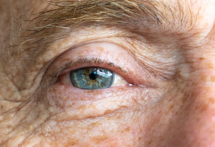 Discover what cataracts are, what causes them, as well as what treatment options you may have.